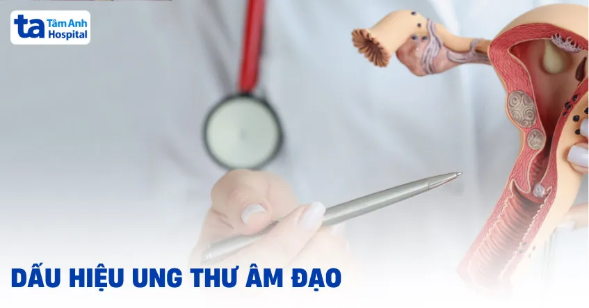 Ung thư âm đạo (vùng kín): Nguyên nhân, dấu hiệu và chẩn đoán