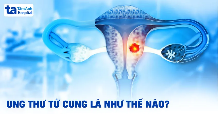 Ung thư tử cung: Nguyên nhân, dấu hiệu, chẩn đoán và phòng ngừa